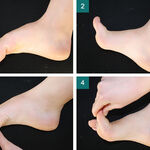 HALLUX VALGUS, ANEB LODIČKY NEBO ŽABKY?